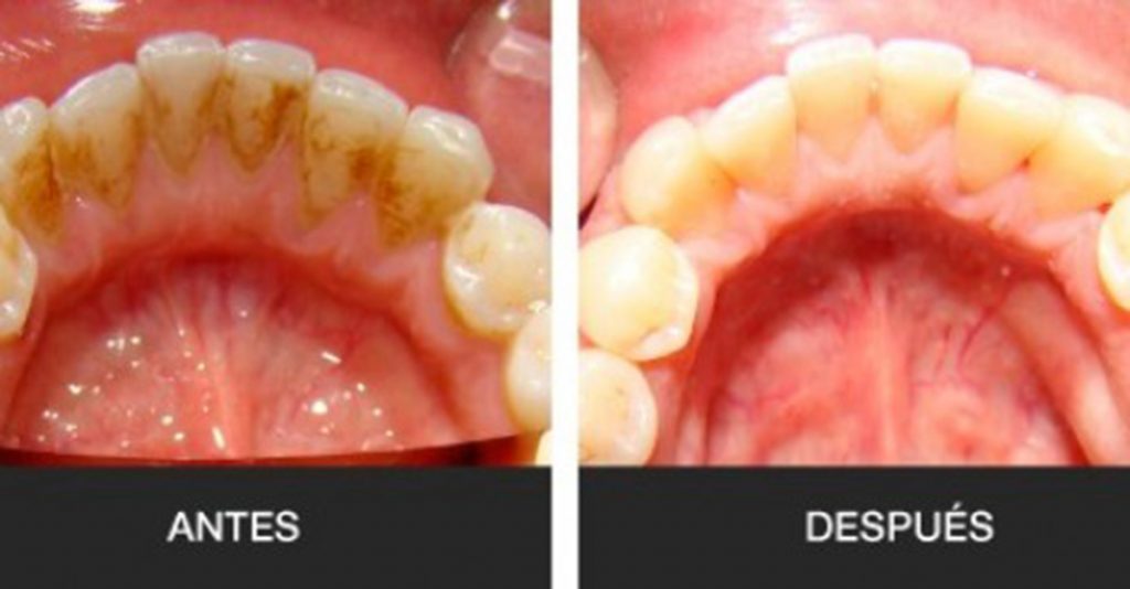 2 Maneras Sencillas De Eliminar El Sarro De Tus Dientes Rápidamente